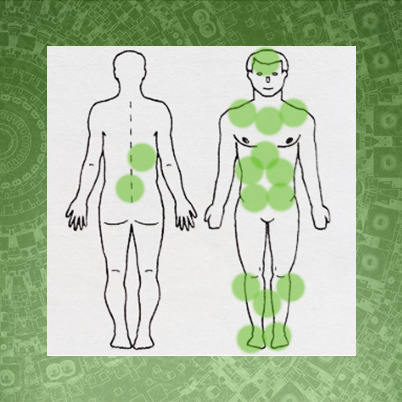 Гирудотерапия в комплексном лечении сахарного диабета 2 типа