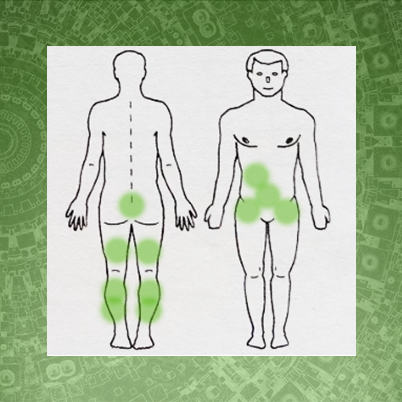 Гирудотерапия при варикозной болезни